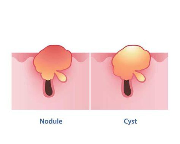 What is the difference between a nodule and a lump?