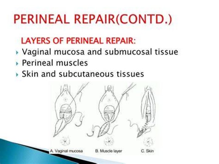 What is the incision through the vaginal wall and perineum?