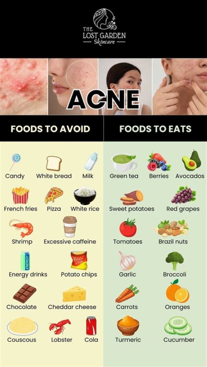 What should I avoid eating for acne?
