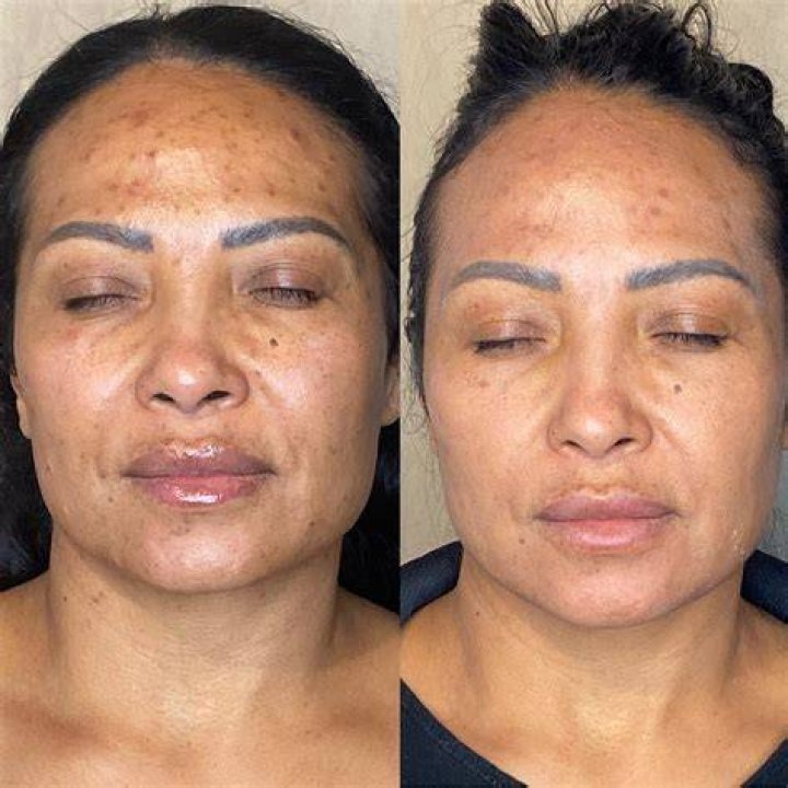 What should I put on my face after microdermabrasion?