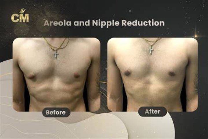 When can I stop covering my nipples after top surgery?
