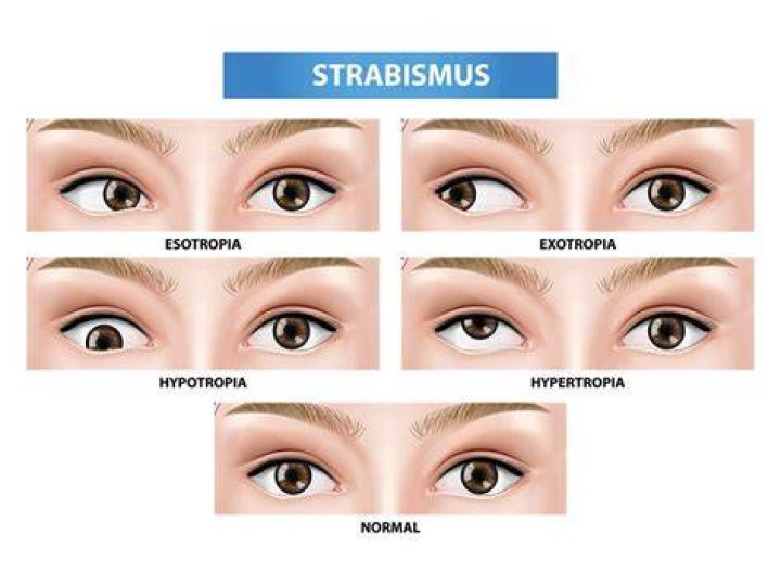When should strabismus resolve?