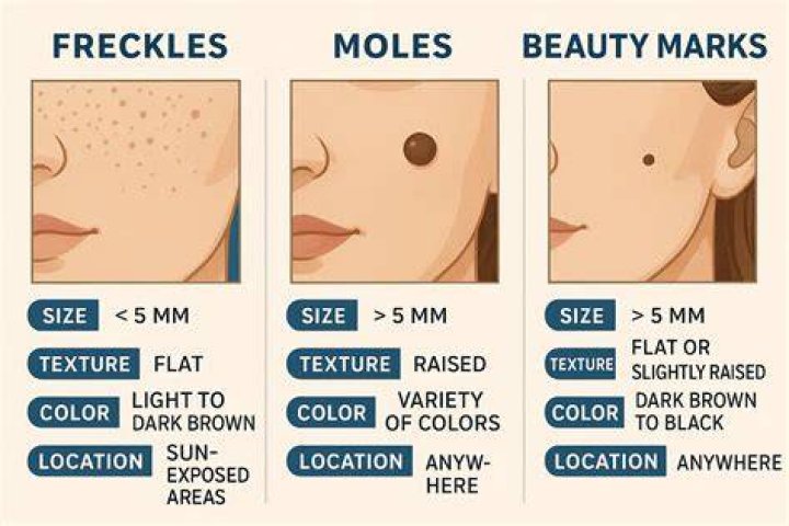 Where do freckles originate from?