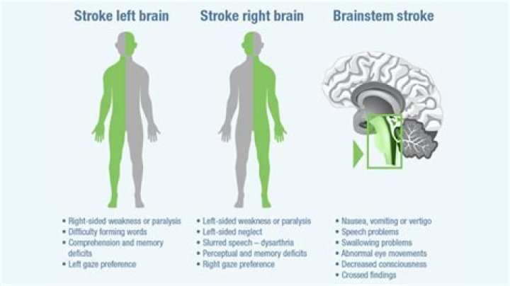 Which side of the brain is worse to have a stroke?