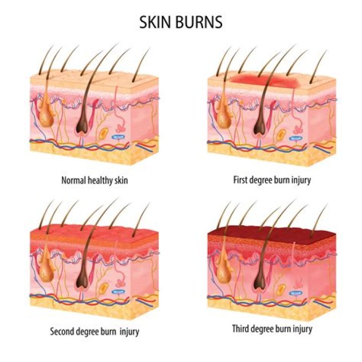 Why do burns turn white?