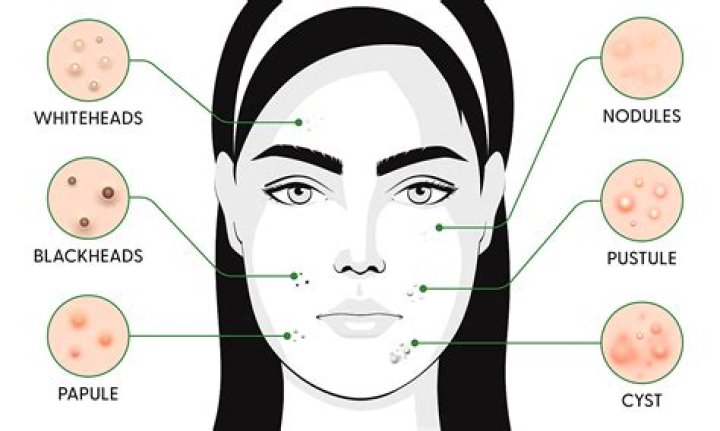 Why do I get pimples after microneedling?