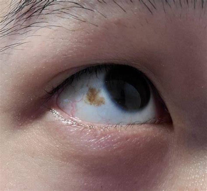 Why do I have a brown spot on my eye?