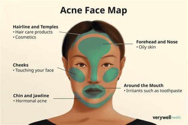 Why do I have pimples on my forehead?