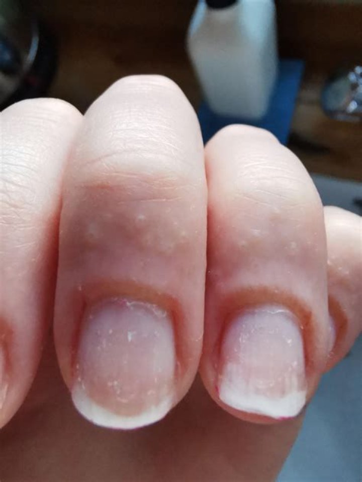 Why do my fingers itch after acrylic nails?