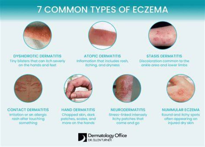 Why does my eczema turn white?