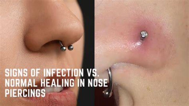 Will an infected piercing heal itself?
