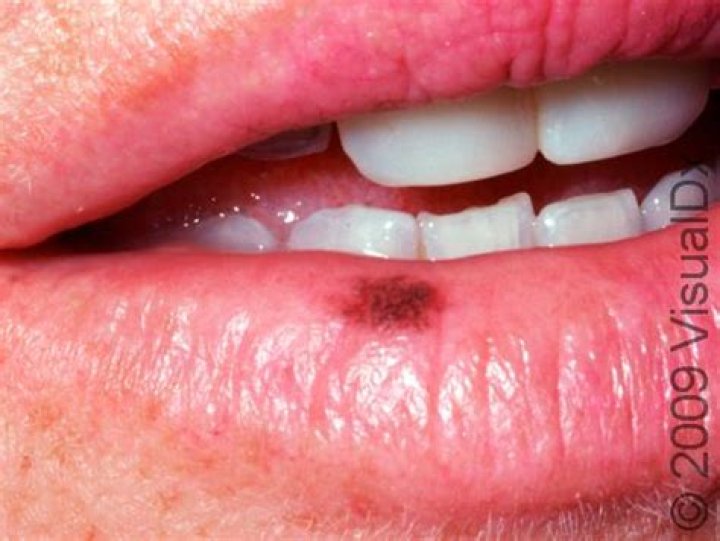 Will black spot on lip go away?