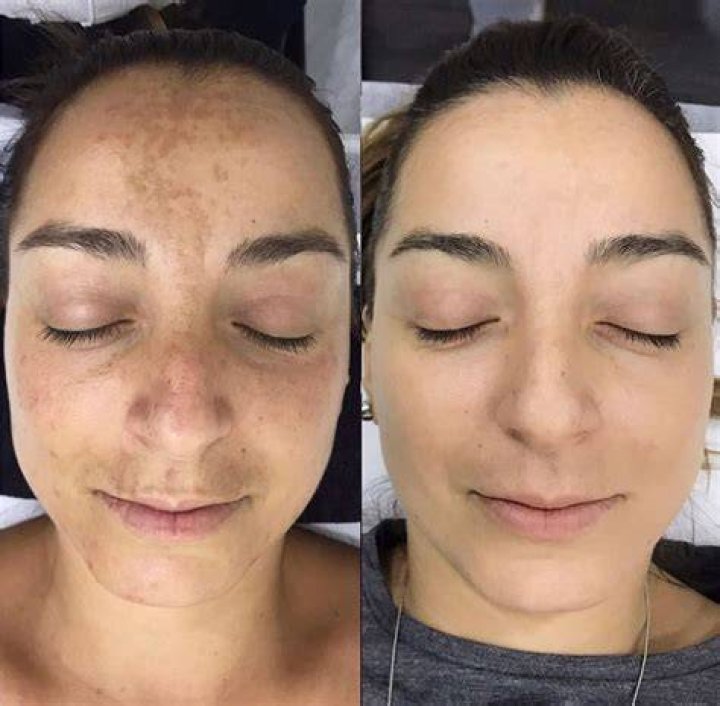 Will microdermabrasion remove freckles?