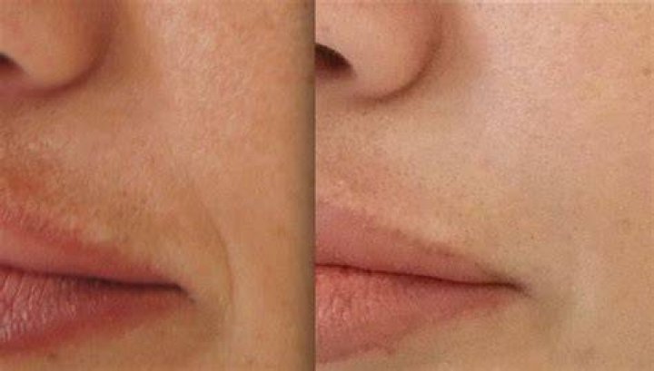 Will microneedling help nasolabial folds?